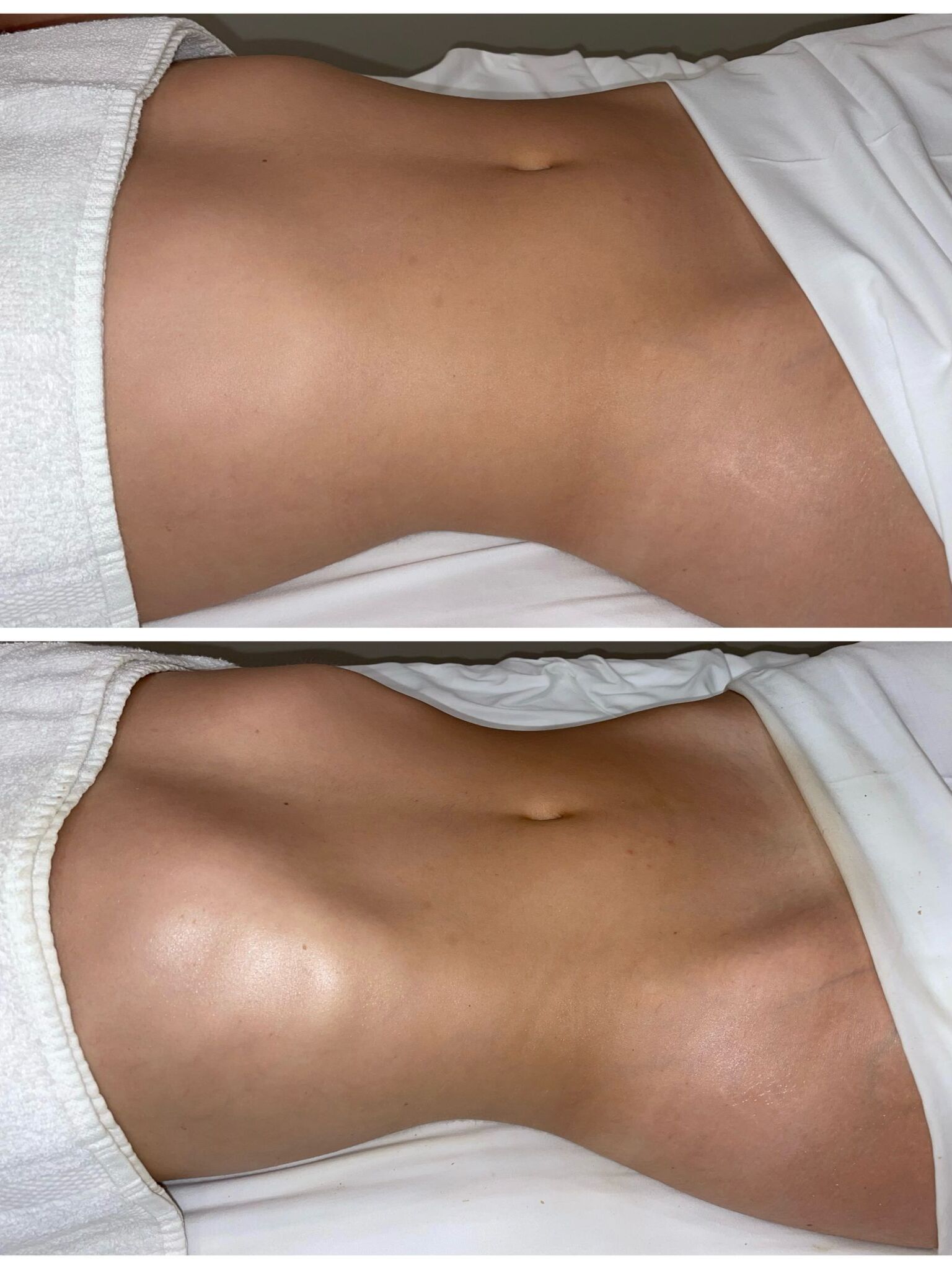 Body contouring 2